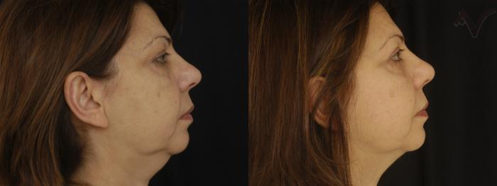 Before & After Facelift Case 227 Right Side View in Los Angeles, CA