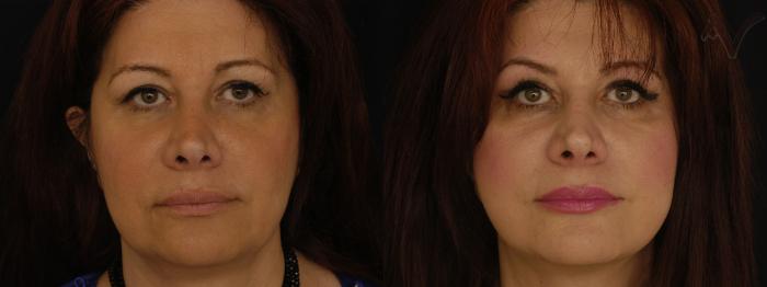 Before & After Facelift Case 230 Front View in Los Angeles, CA