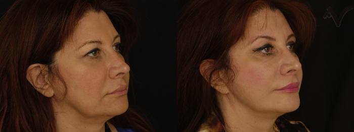 Before & After Facelift Case 230 Right Oblique View in Los Angeles, CA