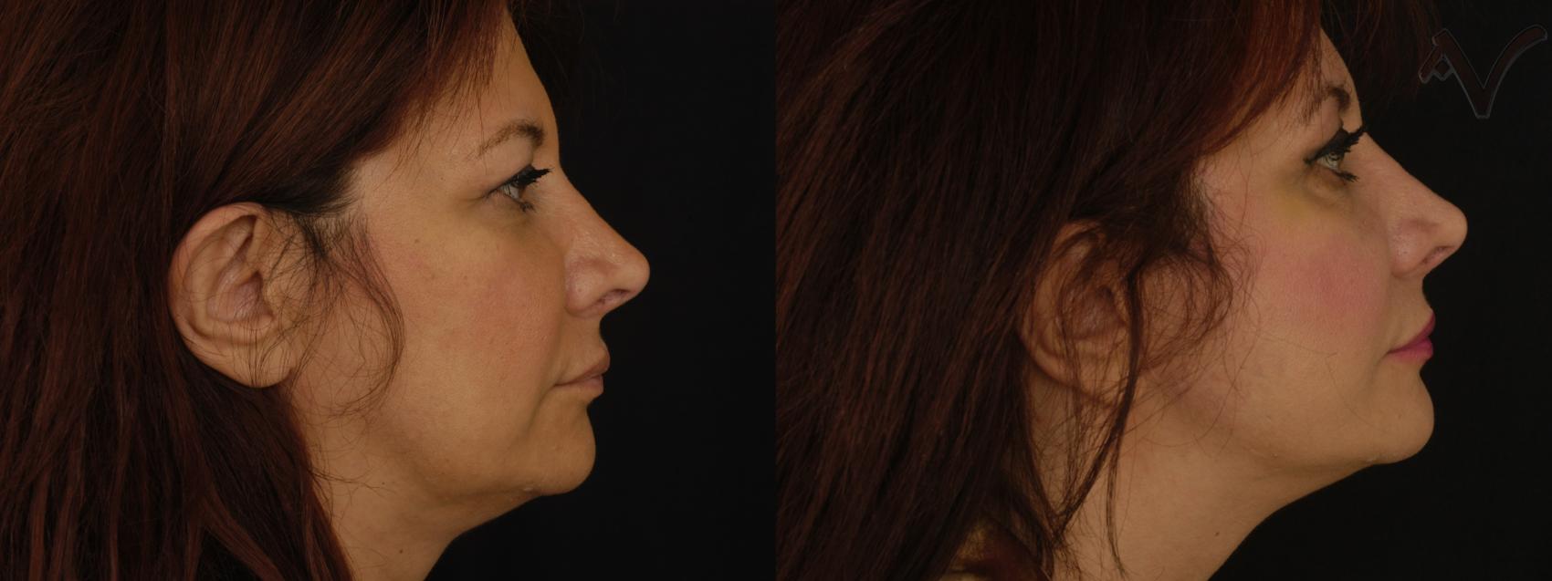 Before & After Facelift Case 230 Right Side View in Burbank, CA