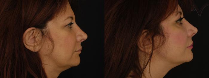 Before & After Facelift Case 230 Right Side View in Los Angeles, CA