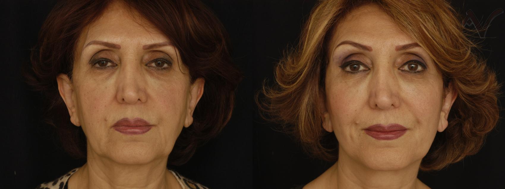 Before & After Facelift Case 231 Front View in Los Angeles, CA