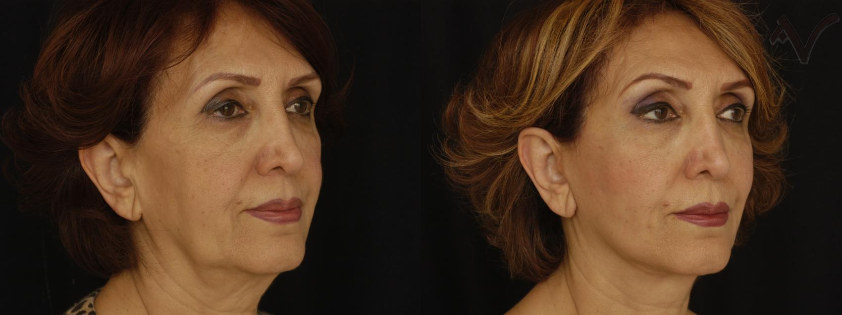 Before & After Facelift Case 231 Right Oblique View in Burbank, CA