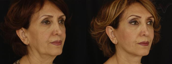 Before & After Facelift Case 231 Right Oblique View in Los Angeles, CA