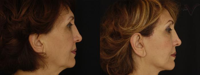 Before & After Facelift Case 231 Right Side View in Los Angeles, CA