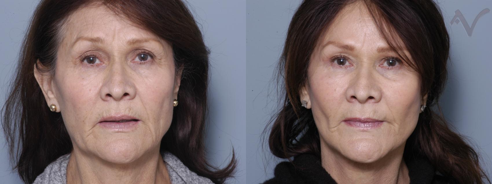 Before & After Facelift Case 233 Front View in Burbank, CA
