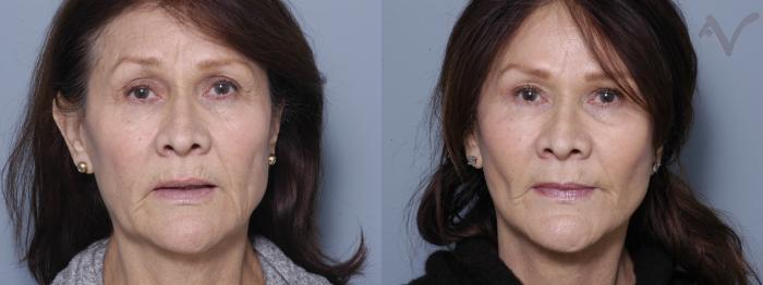 Before & After Facelift Case 233 Front View in Los Angeles, CA