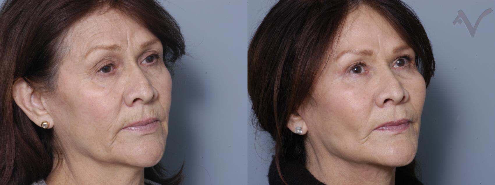 Before & After Facelift Case 233 Right Oblique View in Burbank, CA
