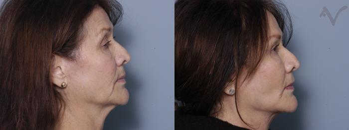 Before & After Facelift Case 233 Right Side View in Los Angeles, CA