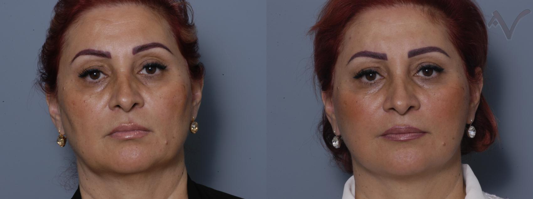 Before & After Facelift Case 234 Front View in Burbank, CA