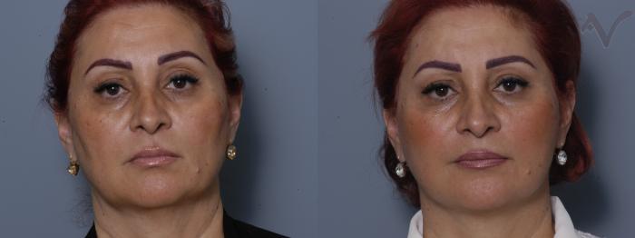 Before & After Facelift Case 234 Front View in Los Angeles, CA