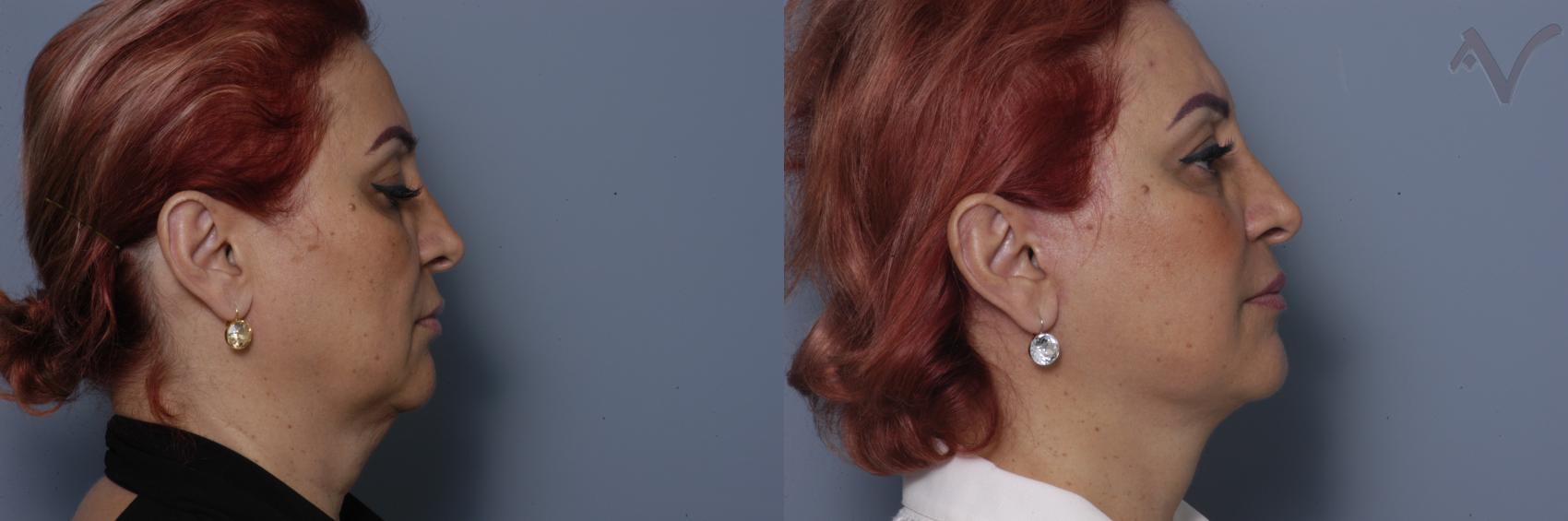 Before & After Facelift Case 234 Right Side View in Los Angeles, CA