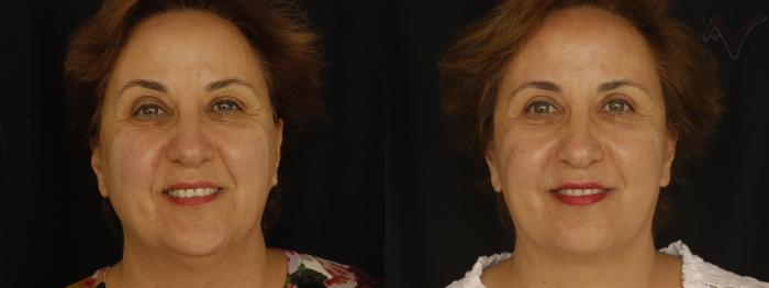 Before & After Facelift Case 361 Front View in Los Angeles, CA