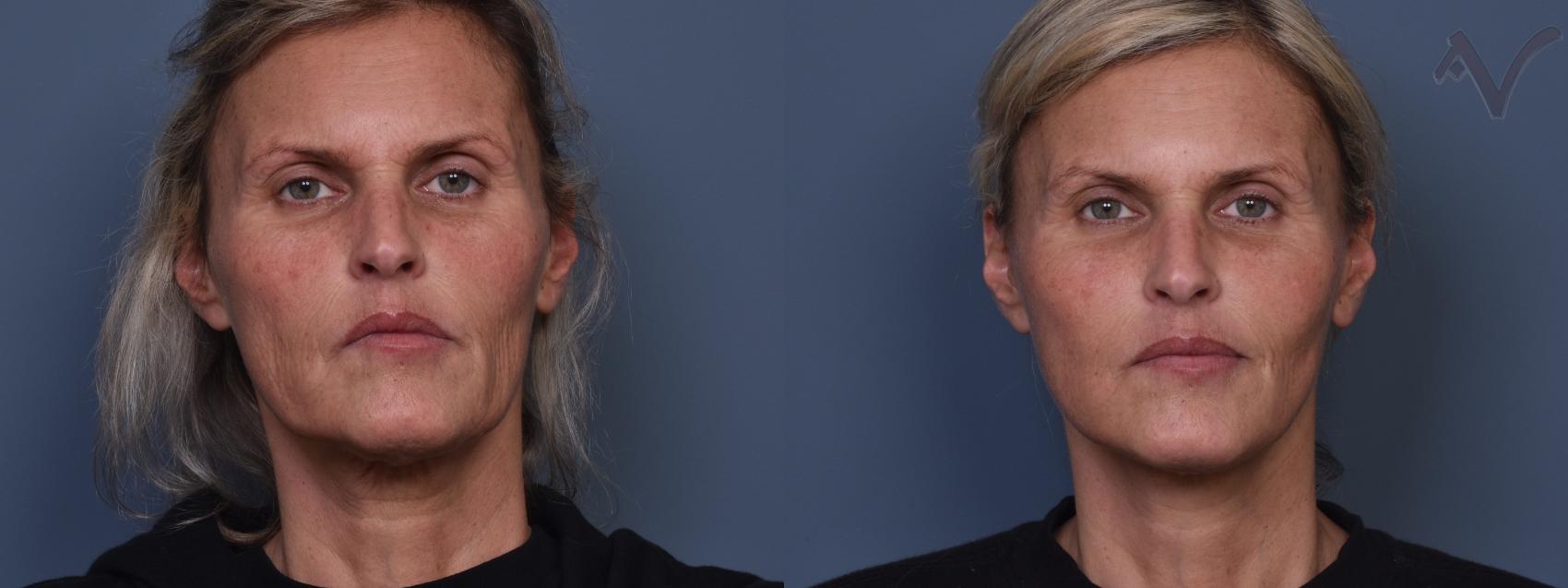 Before & After Facelift Case 421 Front View in Los Angeles, CA