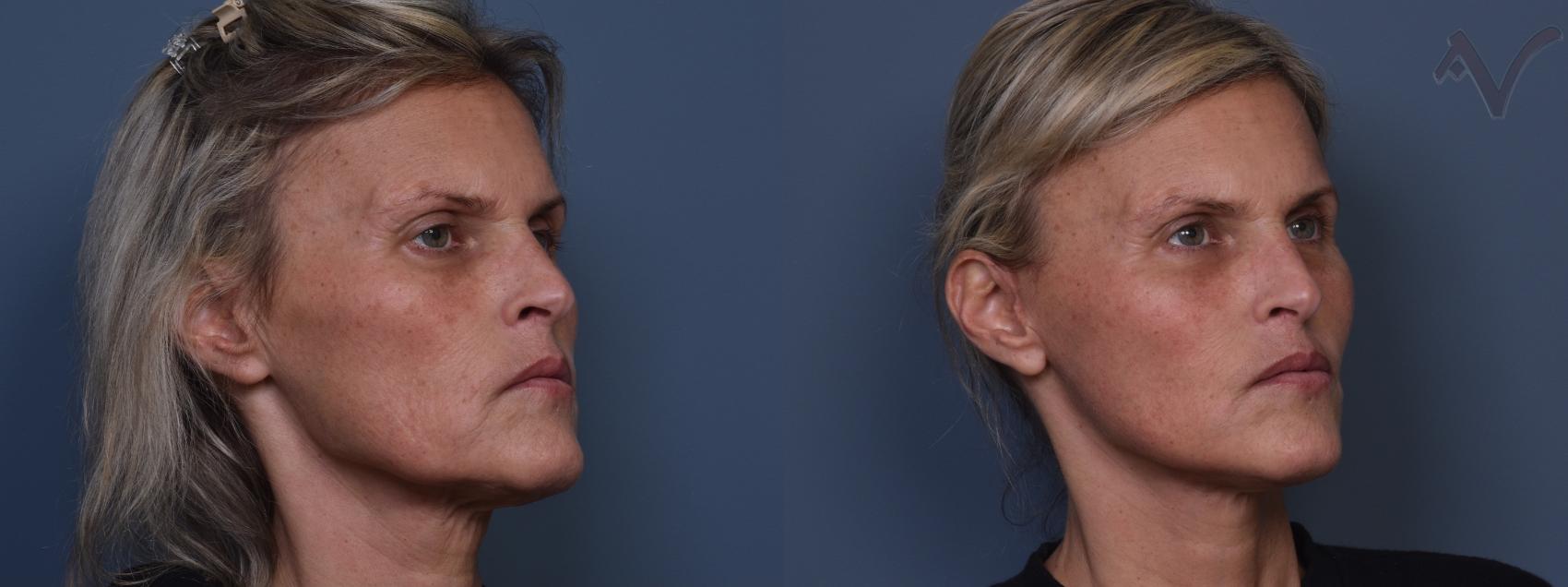 Before & After Facelift Case 421 Right Oblique View in Los Angeles, CA