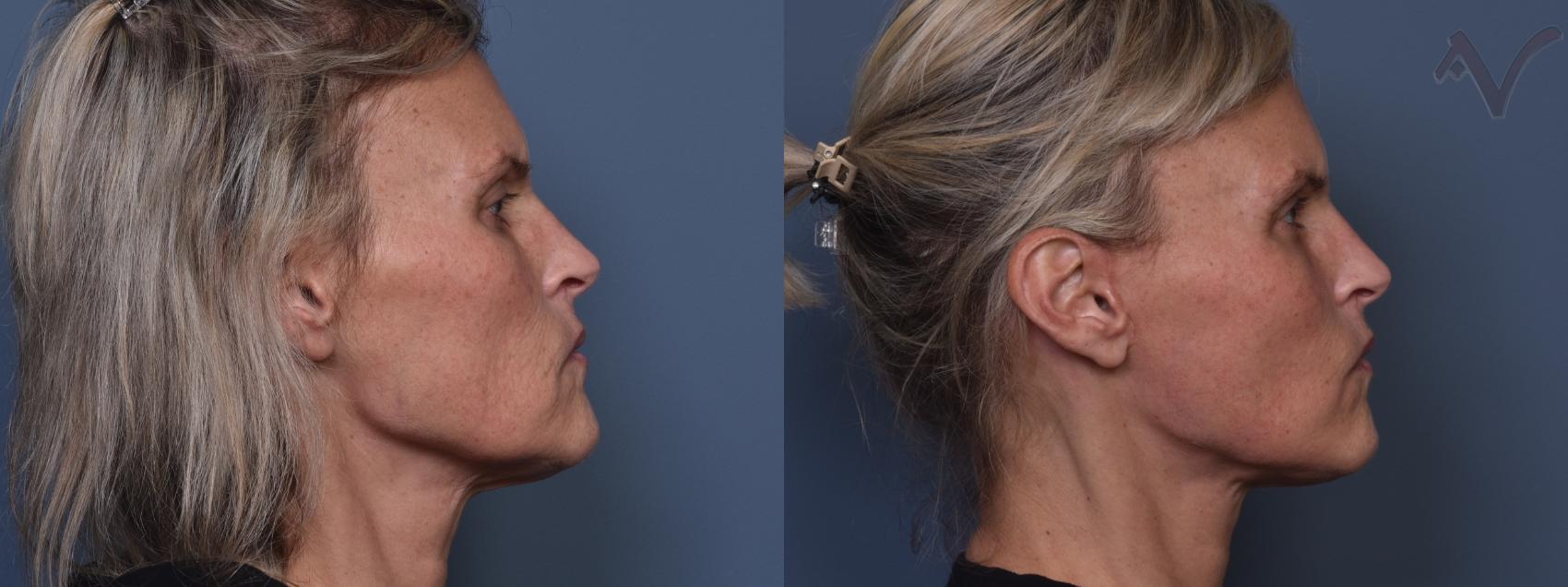 Before & After Facelift Case 421 Right Side View in Los Angeles, CA