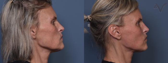 Before & After Facelift Case 421 Right Side View in Los Angeles, CA