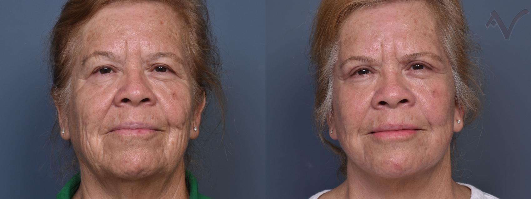 Before & After Facelift Case 422 Front View in Los Angeles, CA