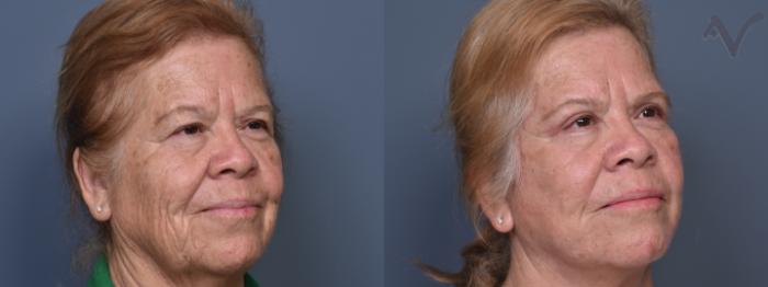 Before & After Facelift Case 422 Right Oblique View in Los Angeles, CA