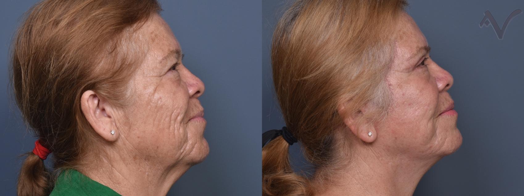 Before & After Facelift Case 422 Right Side View in Los Angeles, CA