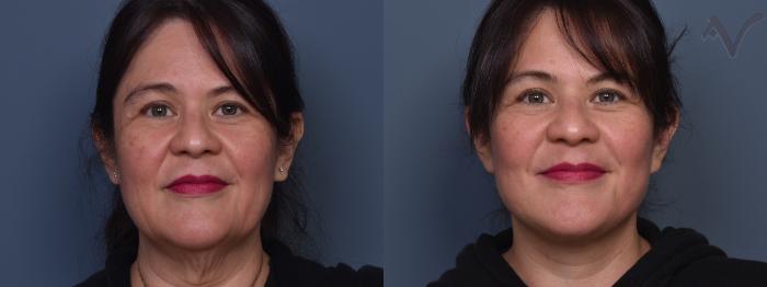 Before & After Facelift Case 459 Front View in Los Angeles, CA
