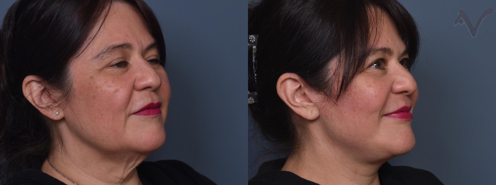 Before & After Facelift Case 459 Right Oblique View in Los Angeles, CA