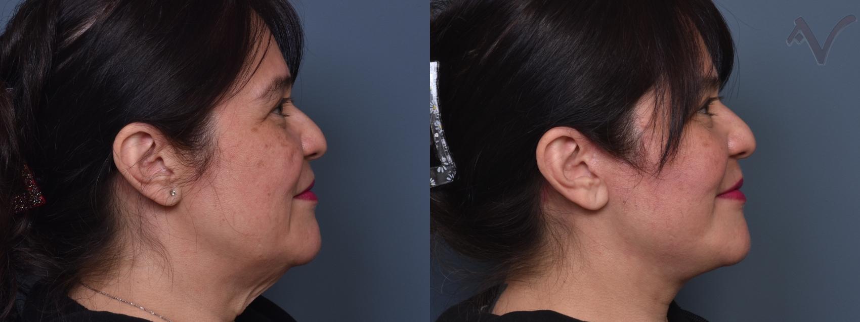 Before & After Facelift Case 459 Right Side View in Los Angeles, CA