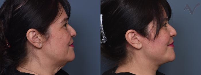 Before & After Facelift Case 459 Right Side View in Los Angeles, CA