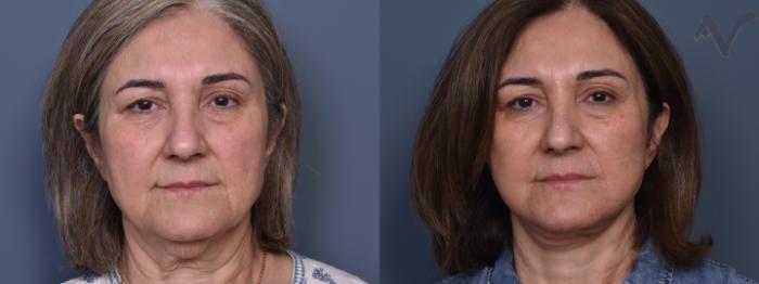 Before & After Facelift Case 460 Front View in Los Angeles, CA
