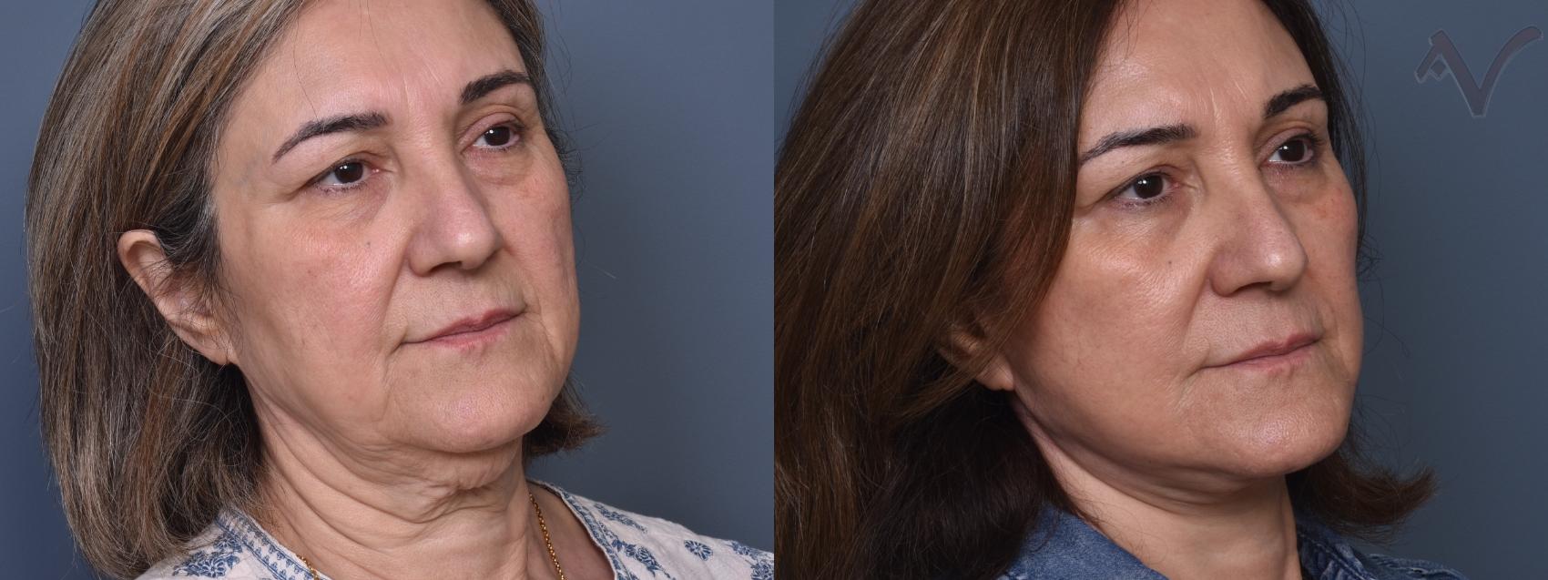 Before & After Facelift Case 460 Left Side View in Los Angeles, CA