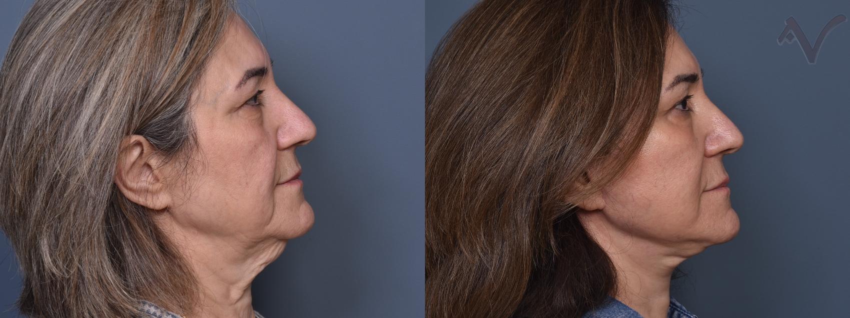 Before & After Facelift Case 460 Right Side View in Los Angeles, CA