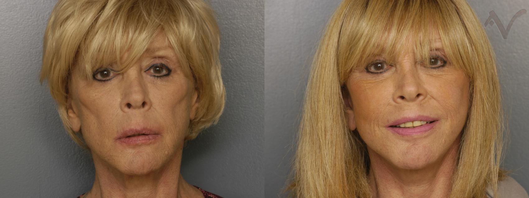 Before & After Facelift Case 461 Front View in Los Angeles, CA