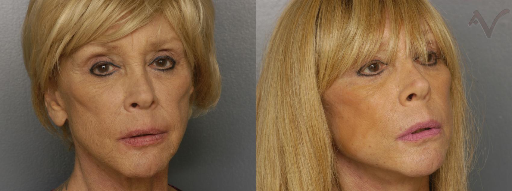Before & After Facelift Case 461 Right Oblique View in Los Angeles, CA