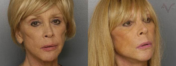 Before & After Facelift Case 461 Right Oblique View in Los Angeles, CA