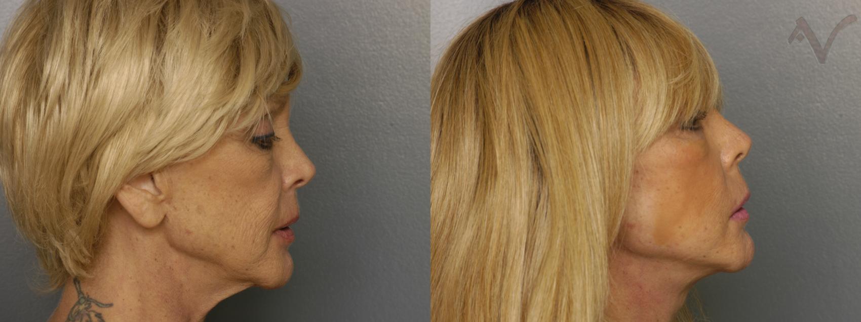 Before & After Facelift Case 461 Right Side View in Los Angeles, CA