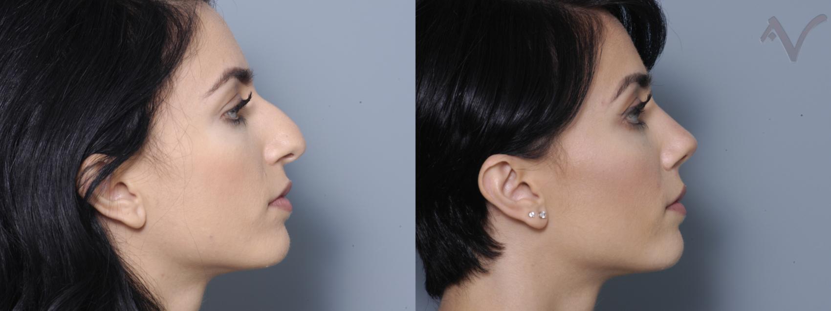 Before & After Rhinoplasty Case 358 Right Side View in Los Angeles, CA