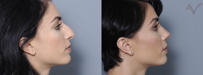 Before & After Featured Case 358 Right Side View in Los Angeles, CA