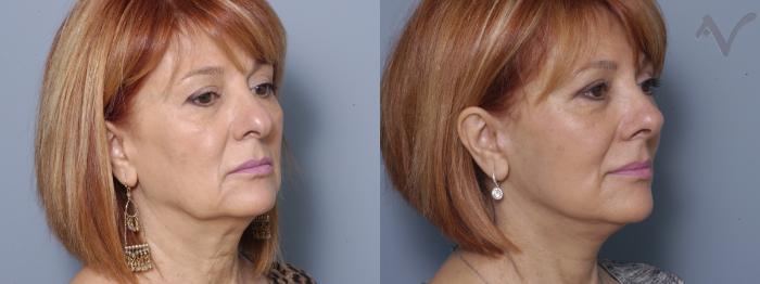 Before & After Featured Case 360 Right Oblique View in Los Angeles, CA