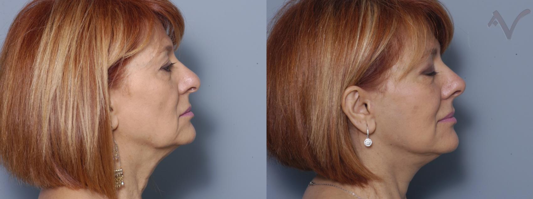 Before & After Featured Case 360 Right Side View in Los Angeles, CA