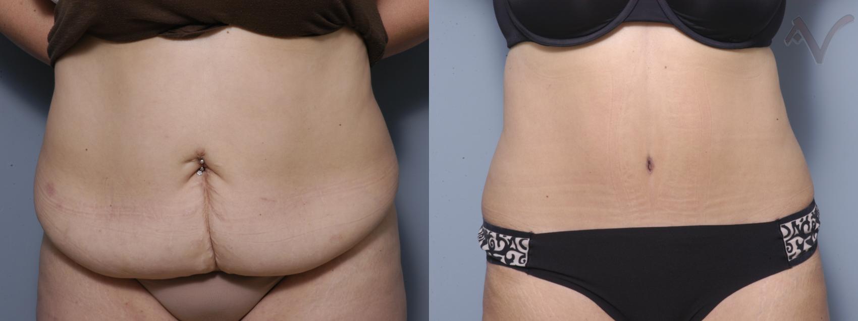 Tummy Tuck Before and After Pictures Case 364