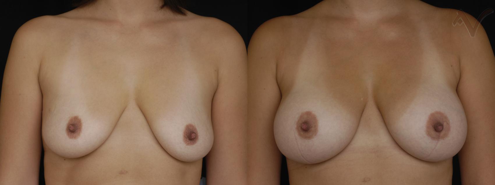 Before & After Featured Case 365 Front View in Los Angeles, CA