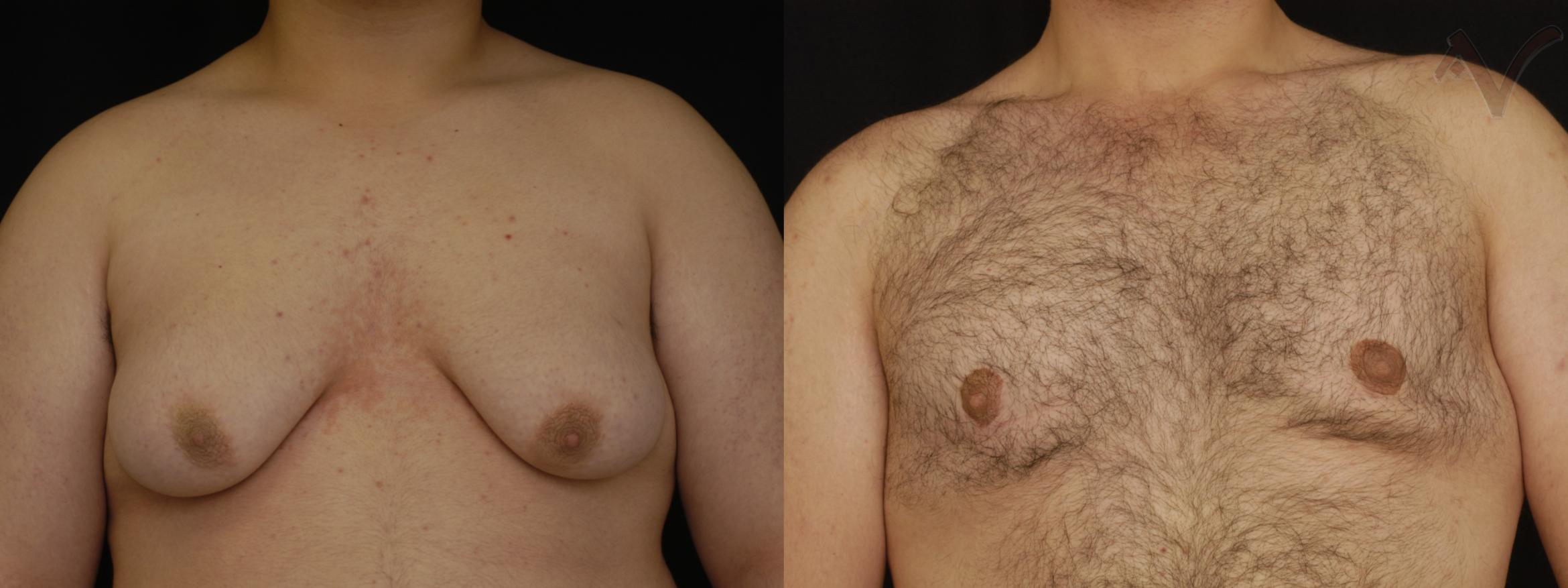 Before & After Male Breast Reduction Case 100 Front View in Burbank, CA