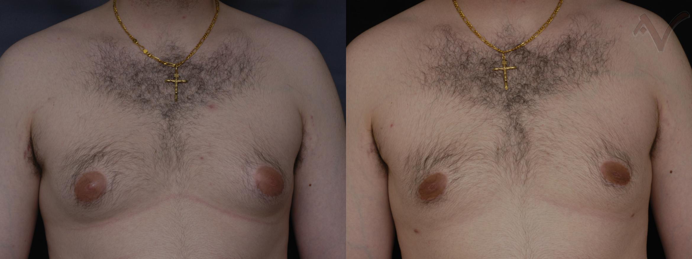 Before & After Male Breast Reduction Case 101 Front View in Burbank, CA