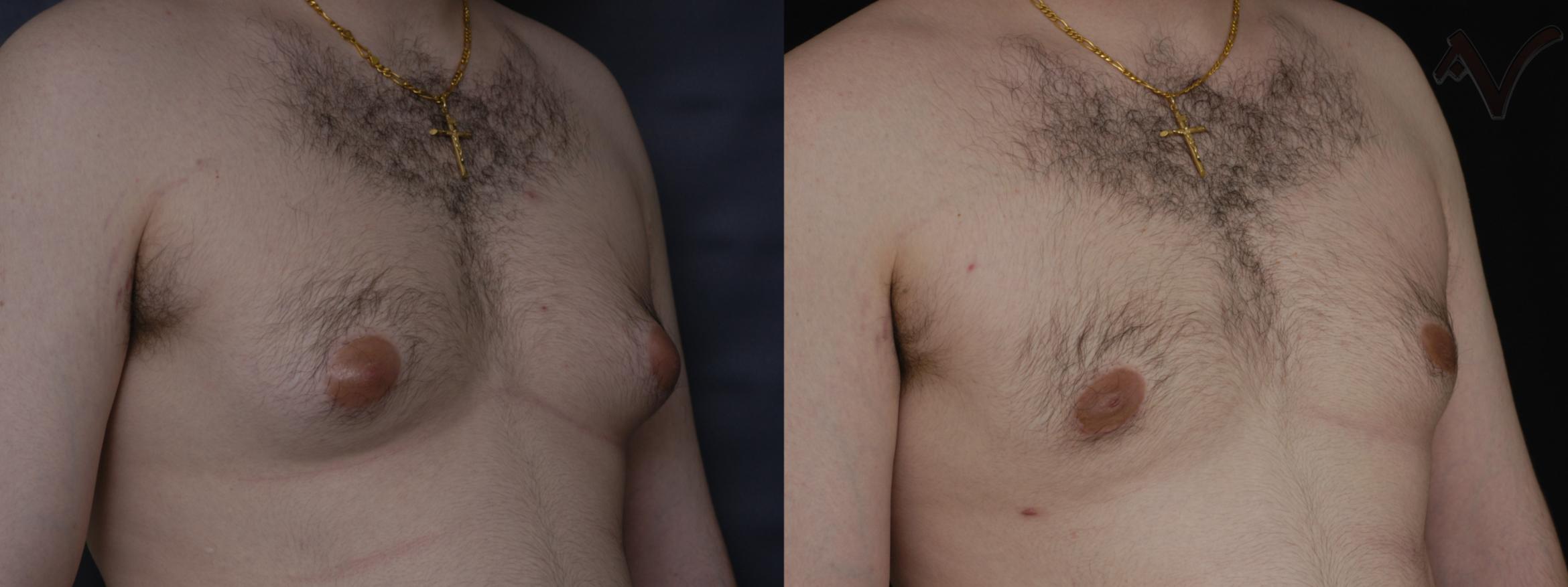 Before & After Male Breast Reduction Case 101 Right Oblique View in Burbank, CA