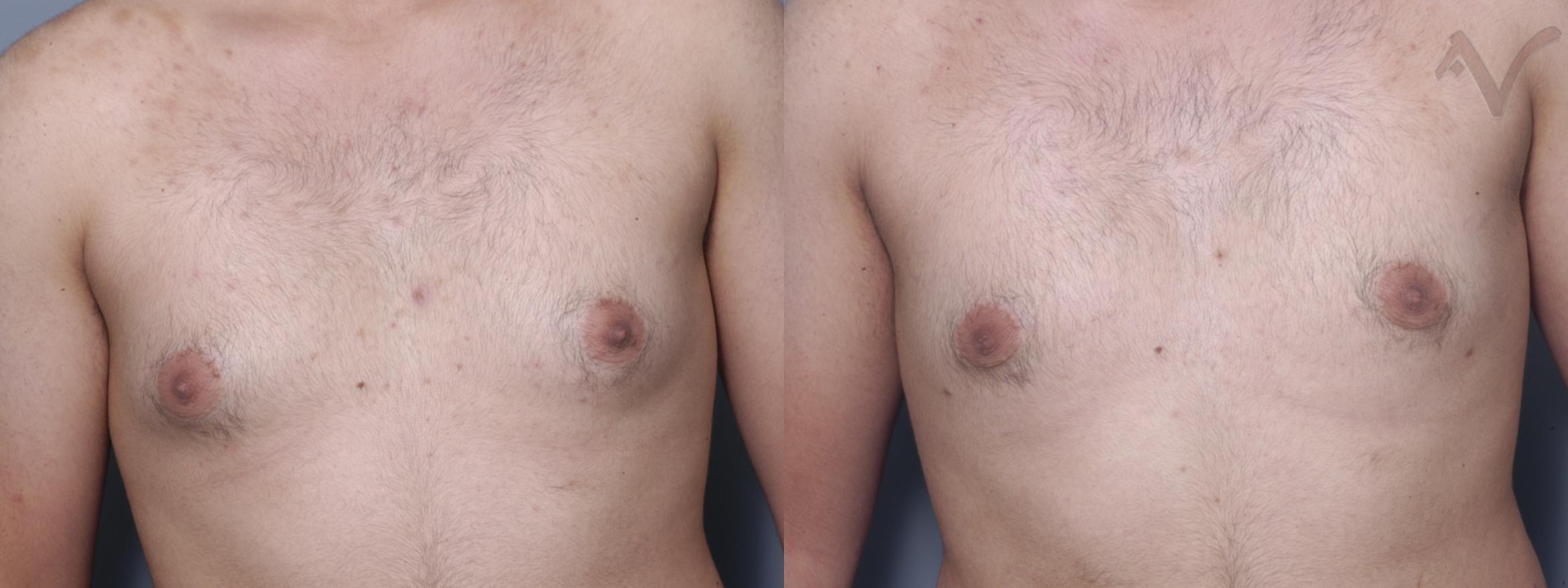 Before & After Male Breast Reduction Case 102 Front View in Los Angeles, CA
