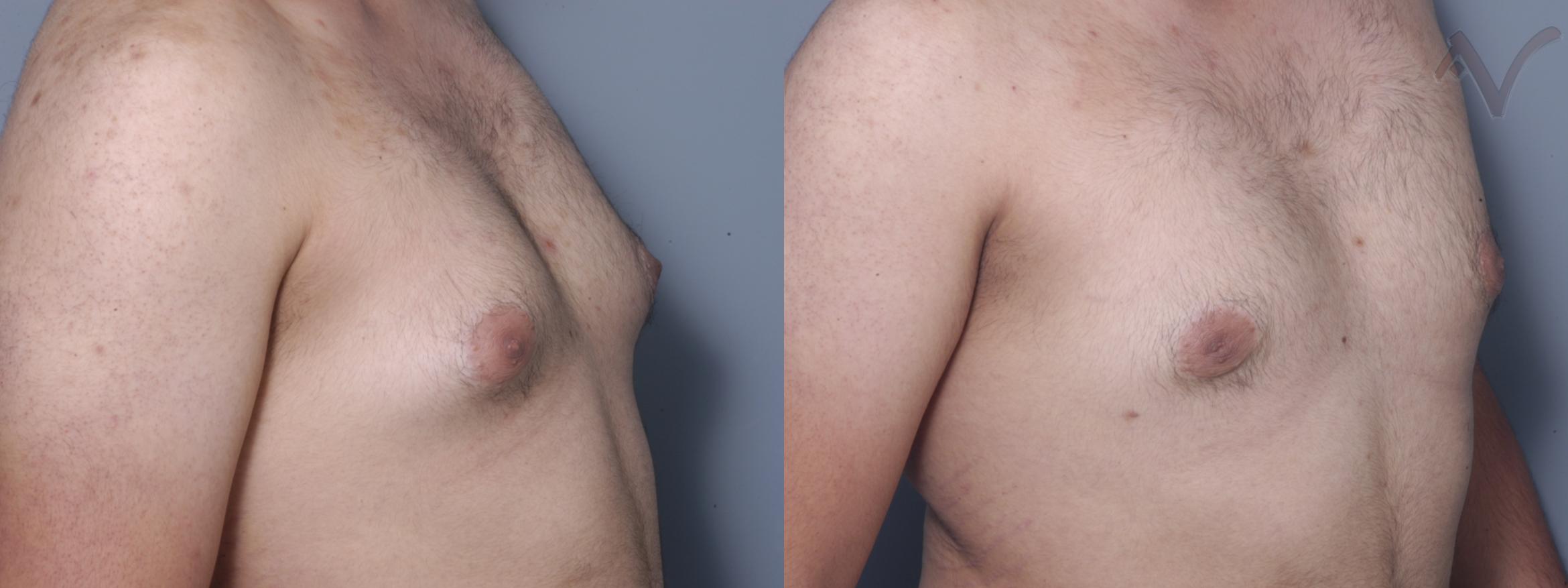 Before & After Male Breast Reduction Case 102 Right Oblique View in Burbank, CA