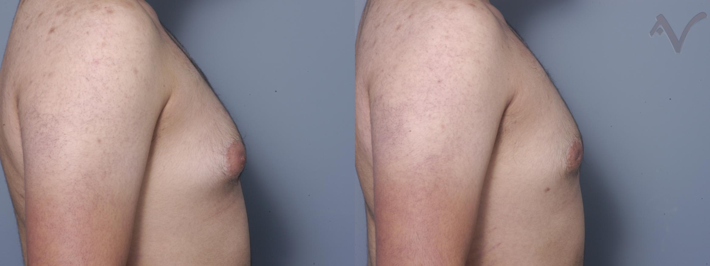 Before & After Male Breast Reduction Case 102 Right Side View in Burbank, CA