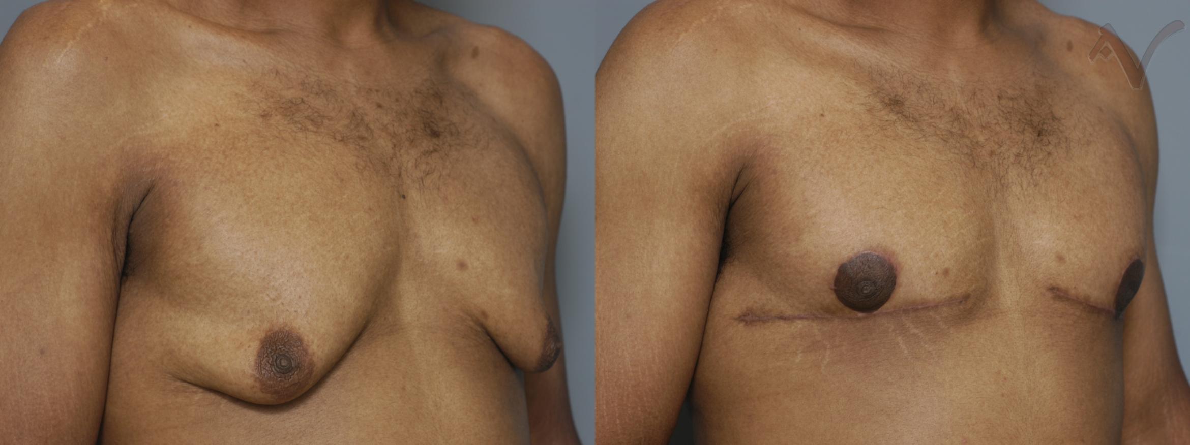 Before & After Male Breast Reduction Case 98 Right Oblique View in Burbank, CA