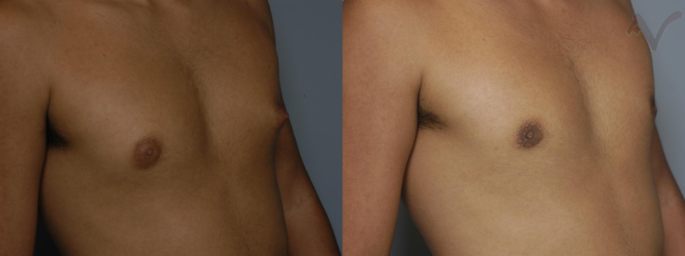 Before & After Male Breast Reduction Case 99 Right Oblique View in Burbank, CA