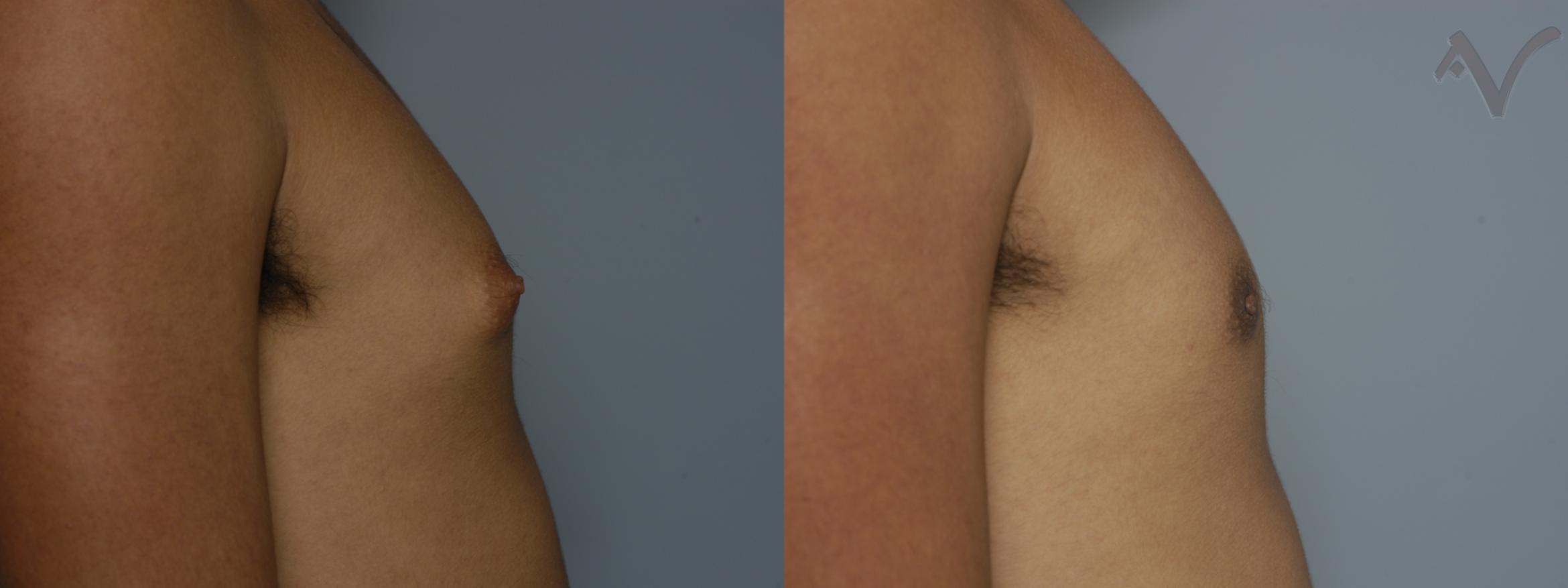 Before & After Male Breast Reduction Case 99 Right Side View in Burbank, CA